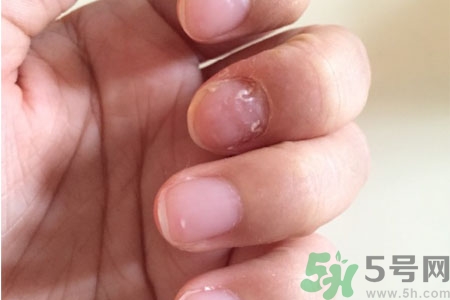 孩子手指甲凹凸不平是什么原因？手指甲凹凸不平的原因是什么？