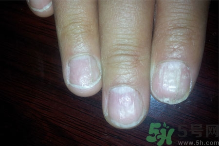 孩子手指甲凹凸不平是什么原因？手指甲凹凸不平的原因是什么？