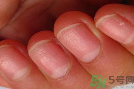 手指甲凹凸不平是怎么回事？如何預(yù)防手指甲凹凸不平？