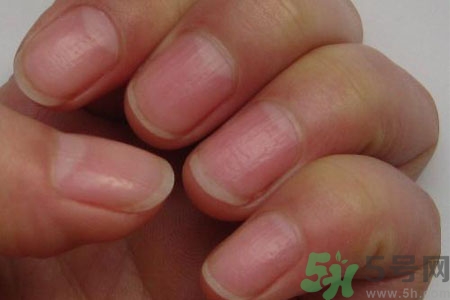 手指甲凹凸不平是怎么回事？如何預(yù)防手指甲凹凸不平？