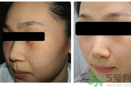 激光縮毛孔多少錢一次？激光縮毛孔一個(gè)療程多少錢？