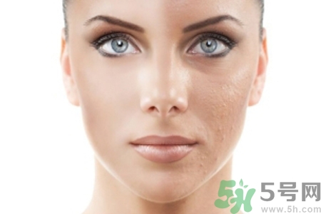 激光縮毛孔多少錢一次？激光縮毛孔一個(gè)療程多少錢？