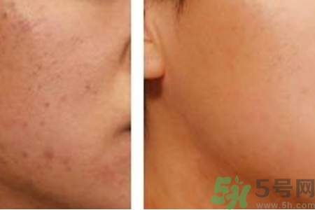 毛孔粗大的原因是什么？激光可以改善毛孔粗大嗎？