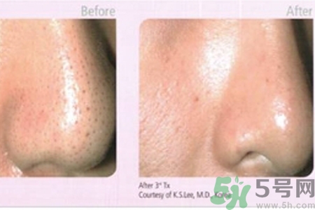 毛孔粗大的原因是什么？激光可以改善毛孔粗大嗎？