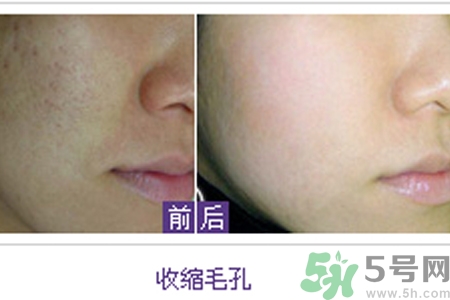 毛孔粗大的原因是什么？激光可以改善毛孔粗大嗎？