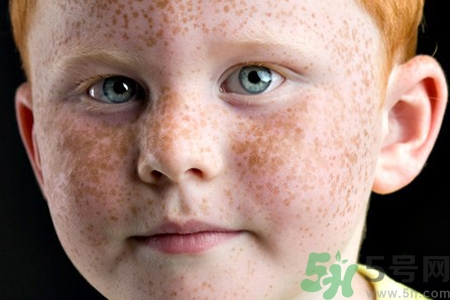 臉上長(zhǎng)雀斑吃什么好？有雀斑不能吃什么？
