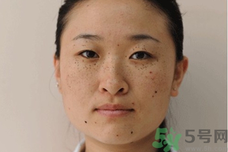 臉上長(zhǎng)雀斑吃什么好？有雀斑不能吃什么？
