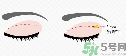 提眉術(shù)后多久可以恢復(fù)？提眉術(shù)后全過程照片