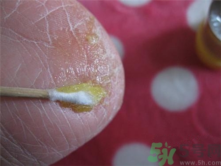 腳跟開裂是什么原因?腳跟裂口怎么辦? 腳跟開裂是什么原因?腳跟裂口怎么辦?