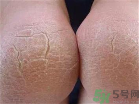 腳跟開裂是什么原因?腳跟裂口怎么辦? 腳跟開裂是什么原因?腳跟裂口怎么辦?