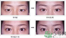 提眉術(shù)后多久可以恢復(fù)？提眉術(shù)后全過程照片