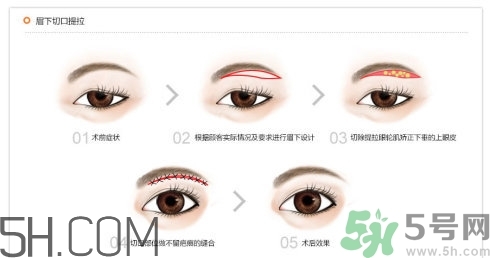 切眉手術(shù)后老得快嗎？切眉能保持多久？