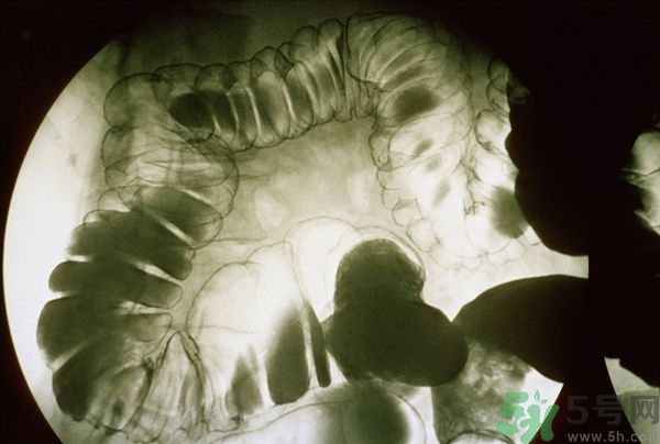 腸炎肚子疼怎么辦？腸炎肚子疼怎么緩解？