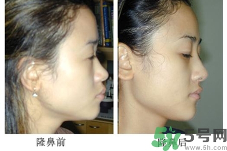 玻尿酸隆鼻的危害有哪些？玻尿酸隆鼻的副作用是什么？