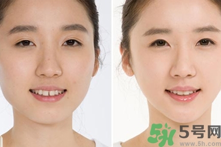 玻尿酸隆鼻的危害有哪些？玻尿酸隆鼻的副作用是什么？