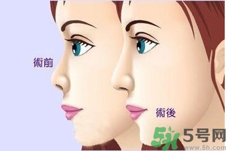 玻尿酸隆鼻的缺點是什么？玻尿酸隆鼻的優(yōu)點有哪些？