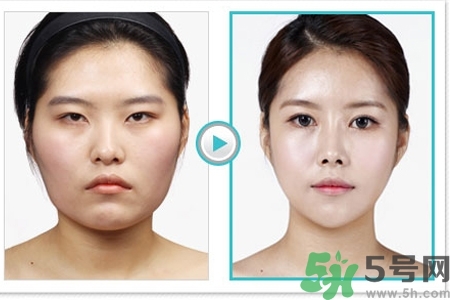 玻尿酸隆鼻的缺點是什么？玻尿酸隆鼻的優(yōu)點有哪些？