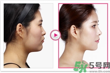 玻尿酸隆鼻的缺點是什么？玻尿酸隆鼻的優(yōu)點有哪些？