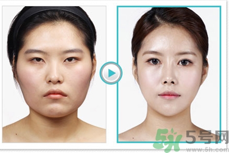 玻尿酸隆鼻和手術(shù)隆鼻的區(qū)別是什么？