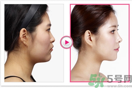 玻尿酸隆鼻和手術(shù)隆鼻的區(qū)別是什么？