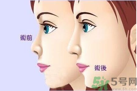 玻尿酸隆鼻和手術(shù)隆鼻的區(qū)別是什么？