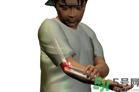 幼年關(guān)節(jié)炎的好發(fā)年齡？幼年關(guān)節(jié)炎別輕易忽視