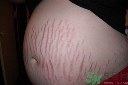 妊娠紋癢是怎么回事？妊娠紋癢怎么辦？