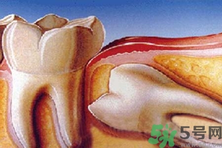 智齒橫著長怎么辦？智齒橫著長一定要拔了嗎？