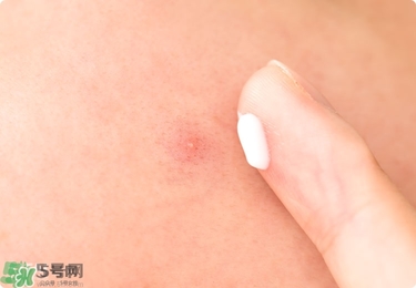 獅王祛痘膏怎么樣？獅王祛痘好用嗎？