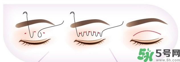 雙眼皮手術(shù)哪種最好？割雙眼皮后注意些什么？