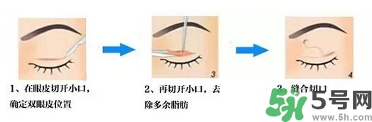 雙眼皮手術(shù)哪種最好？割雙眼皮后注意些什么？