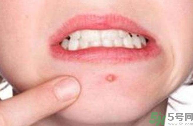 什么樣的痘痘能擠？哪些痘痘不能擠？