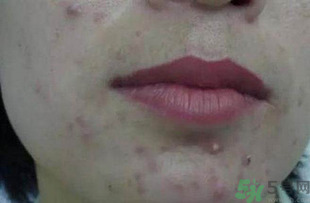 什么樣的痘痘能擠？哪些痘痘不能擠？