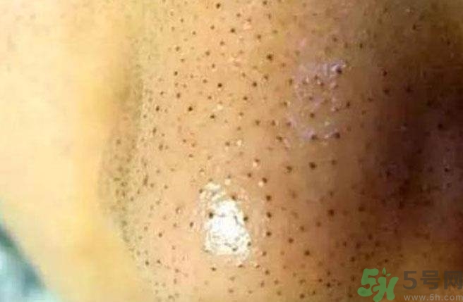 什么樣的痘痘能擠？哪些痘痘不能擠？