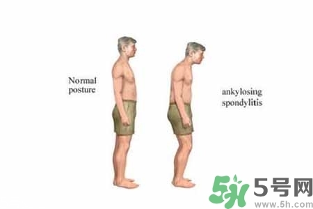 僵直性脊椎炎的癥狀有哪些？怎樣預(yù)防僵直性脊椎炎？