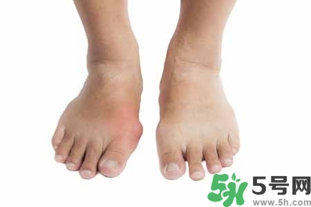 引發(fā)痛風(fēng)的原因是什么？痛風(fēng)病人飲食需注意什么好？