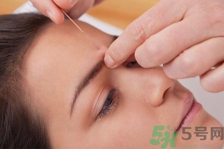 針灸一次要扎多長時間？針灸可以幾天做一次？