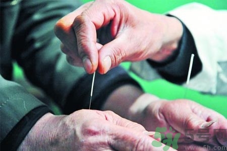 針灸一次要扎多長時間？針灸可以幾天做一次？