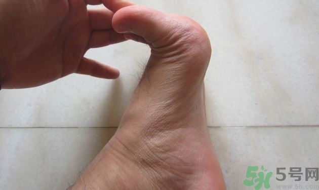 腳拇指外翻遺傳嗎？腳拇指外翻怎么矯正？