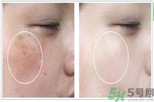 曬斑可以自己消退嗎？曬斑可以用激光去除嗎？