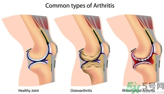類風(fēng)濕關(guān)節(jié)炎的診斷標(biāo)準(zhǔn) 類風(fēng)濕關(guān)節(jié)炎的飲食選擇與禁忌 類風(fēng)濕關(guān)節(jié)炎的診斷標(biāo)準(zhǔn) 類風(fēng)濕關(guān)節(jié)炎的飲食選擇與禁忌