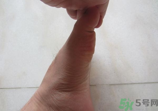 腳拇指外翻遺傳嗎？腳拇指外翻怎么矯正？