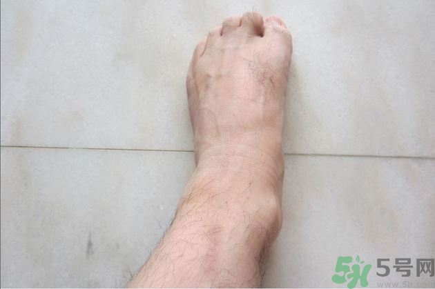 腳拇指外翻遺傳嗎？腳拇指外翻怎么矯正？