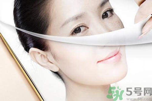 曬斑可以自己消退嗎？曬斑可以用激光去除嗎？