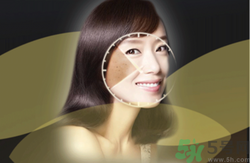 曬斑可以自己消退嗎？曬斑可以用激光去除嗎？