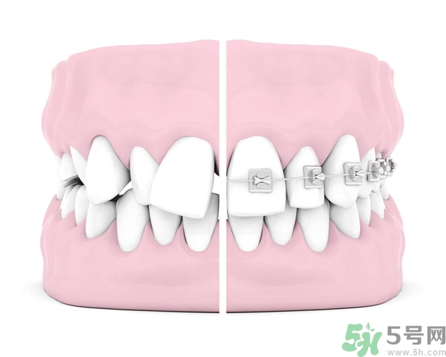 牙齒橫著長(zhǎng)怎么辦？智齒橫著長(zhǎng)一定要拔嗎？