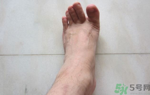 腳拇指外翻遺傳嗎？腳拇指外翻怎么矯正？