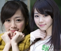 色斑會(huì)自己消失嗎？色斑遺傳嗎？