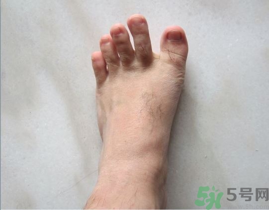 腳拇指外翻遺傳嗎？腳拇指外翻怎么矯正？