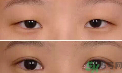 天生腫眼泡怎么消除？天生腫眼泡怎么辦？